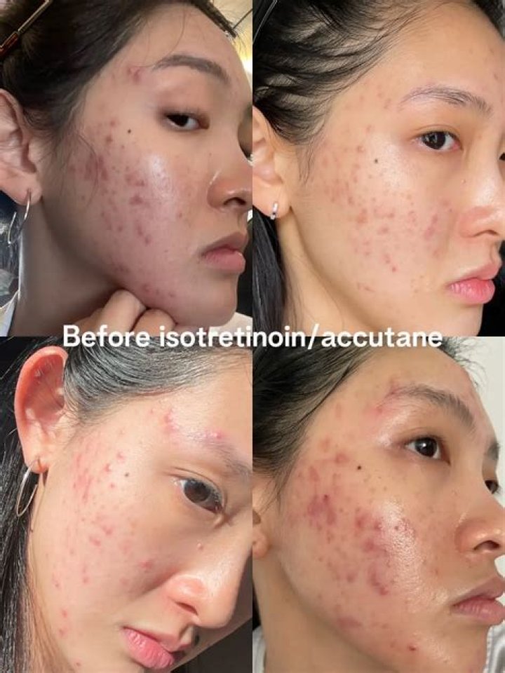 Are Asians more likely to get acne?