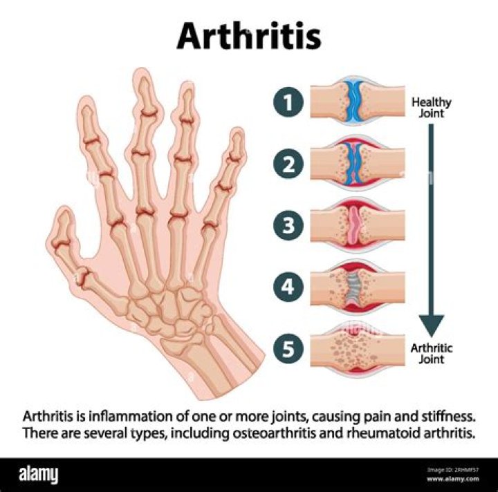 At what age does arthritis usually start?