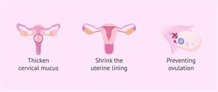 Can IUD cause depression?