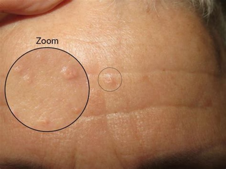 What does sebaceous hyperplasia look like?