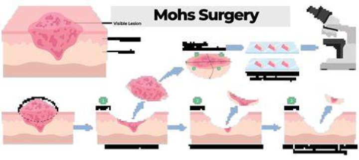 What type of surgeon performs Mohs surgery?